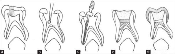 Comparative evaluation of a modified endodontic approach using <i>Curcuma longa</i> L. and conventional pulpectomy in primary molars: A randomized clinical trial.