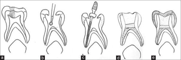 Comparative evaluation of a modified endodontic approach using <i>Curcuma longa</i> L. and conventional pulpectomy in primary molars: A randomized clinical trial.