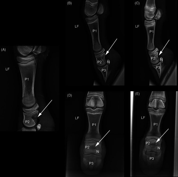 Arthroscopic removal of a solitary osteochondroma interfering with the podotrochlear apparatus in a foal.