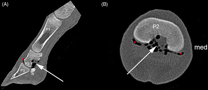 Arthroscopic removal of a solitary osteochondroma interfering with the podotrochlear apparatus in a foal.