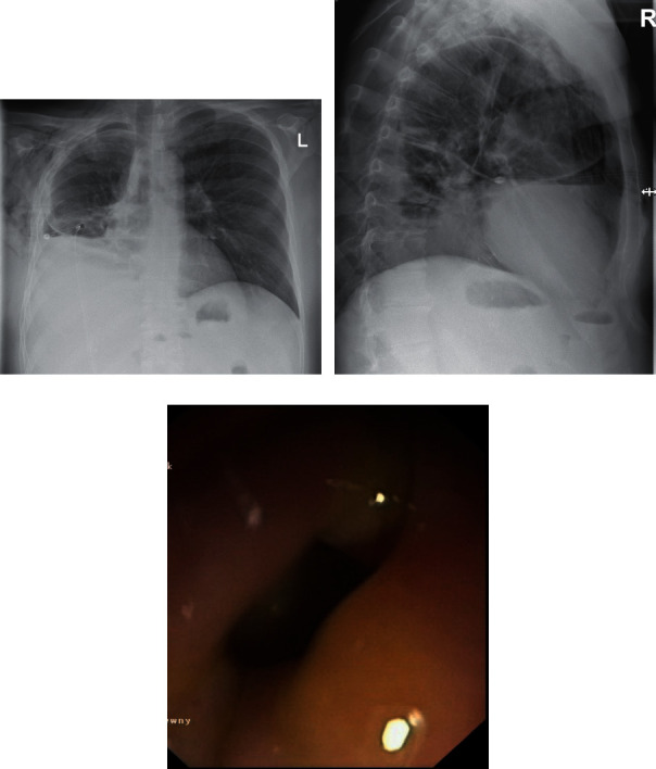 Serious Complications of EUS-Guided Hepaticoesophagostomy due to Transmural Stent Migration.