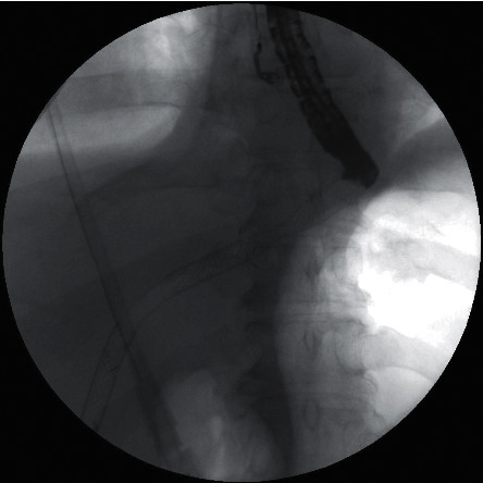 Serious Complications of EUS-Guided Hepaticoesophagostomy due to Transmural Stent Migration.