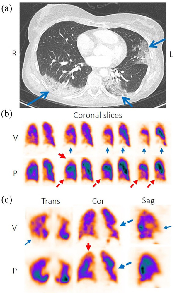 Assessment of Ventilation and Perfusion in Patients with COVID-19 Discloses Unique Information of Pulmonary Function to a Clinician: Case Reports of V/P SPECT.