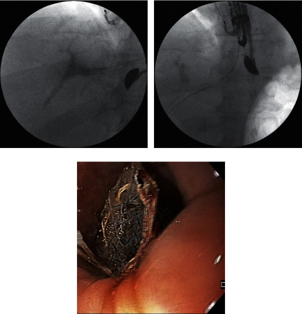 Serious Complications of EUS-Guided Hepaticoesophagostomy due to Transmural Stent Migration.