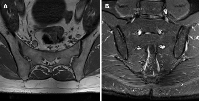 Sacrum magnetic resonance imaging for low back and tail bone pain: A quality initiative to evaluate and improve imaging utility.