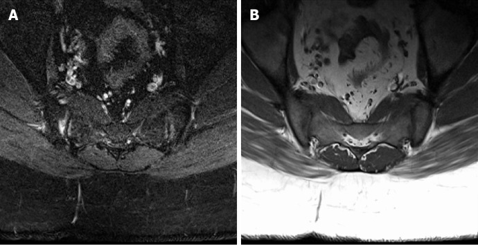 Sacrum magnetic resonance imaging for low back and tail bone pain: A quality initiative to evaluate and improve imaging utility.