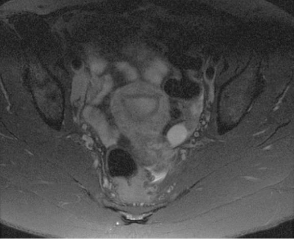 Sacrum magnetic resonance imaging for low back and tail bone pain: A quality initiative to evaluate and improve imaging utility.