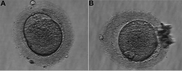 Oocyte Morphology and Reproductive Outcomes - Case Report and Literature Review.