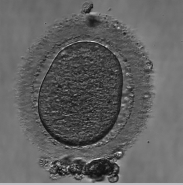 Oocyte Morphology and Reproductive Outcomes - Case Report and Literature Review.