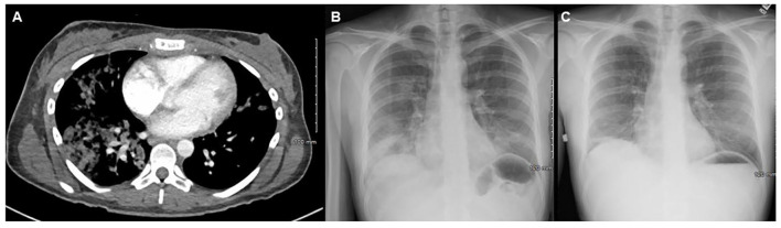 First Case Report of an Unusual Fungus (<i>Sporopachydermia lactativora)</i> Associated with a Pulmonary Infection in a Drug Injection User.
