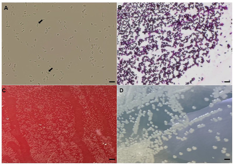First Case Report of an Unusual Fungus (<i>Sporopachydermia lactativora)</i> Associated with a Pulmonary Infection in a Drug Injection User.