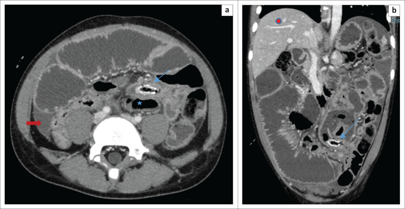 Maximum intensity projection aids in diagnosing acute appendicitis and mobile caecum: A case report and literature review.