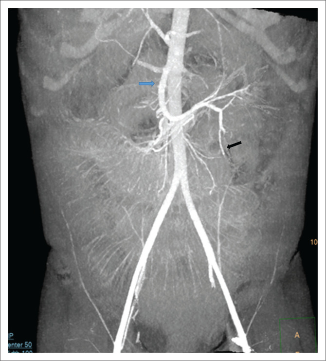 Maximum intensity projection aids in diagnosing acute appendicitis and mobile caecum: A case report and literature review.