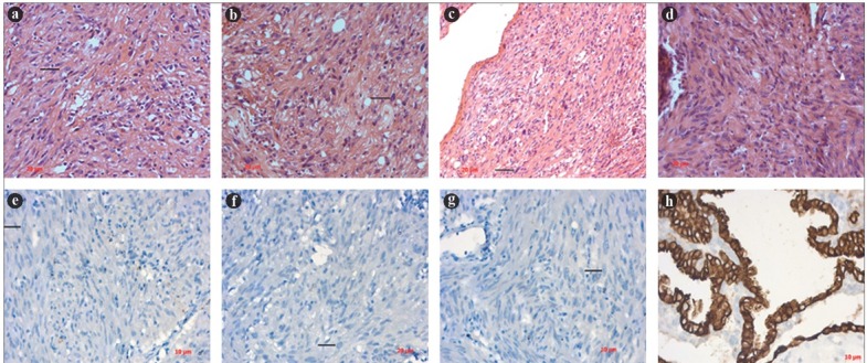 Mutation Status and Immunohistochemical Correlation of <i>EGFR</i> Mutations in Gastrointestinal Stromal Tumors.