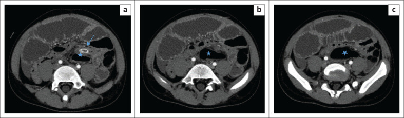 Maximum intensity projection aids in diagnosing acute appendicitis and mobile caecum: A case report and literature review.