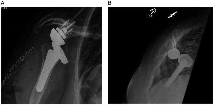 Maximizing Muscle Function in Cuff-Deficient Shoulders: A Rehabilitation Proposal for Reverse Arthroplasty.