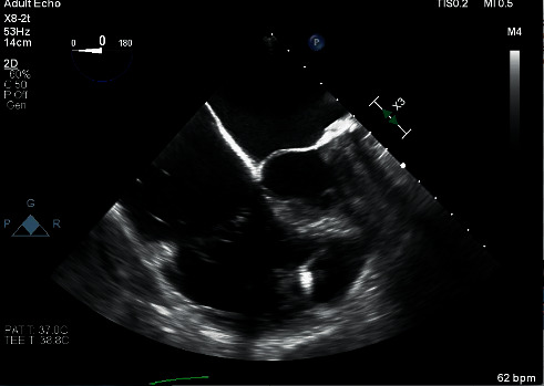 Tricuspid Valve Replacement in a Patient with a Leadless Cardiac Pacemaker: Current Guidelines and Recommendations for Perioperative Management.