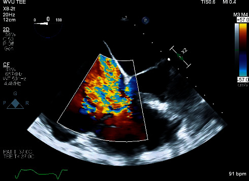 Tricuspid Valve Replacement in a Patient with a Leadless Cardiac Pacemaker: Current Guidelines and Recommendations for Perioperative Management.