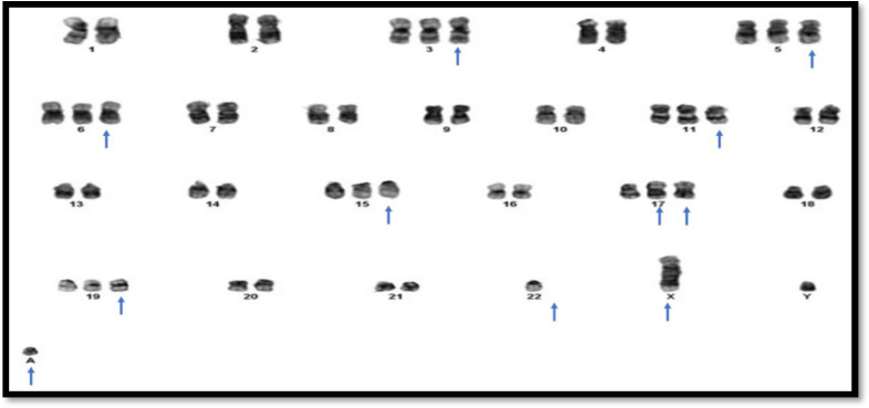 Hyperdiploid Multiple Myeloma with Novel Complex Structural Chromosome Abnormalities Associated with Poor Prognosis : A Rare Case Report.