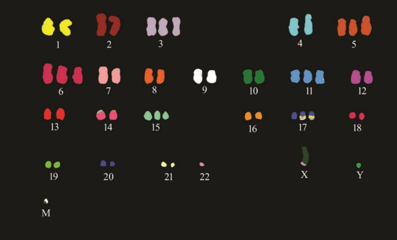 Hyperdiploid Multiple Myeloma with Novel Complex Structural Chromosome Abnormalities Associated with Poor Prognosis : A Rare Case Report.