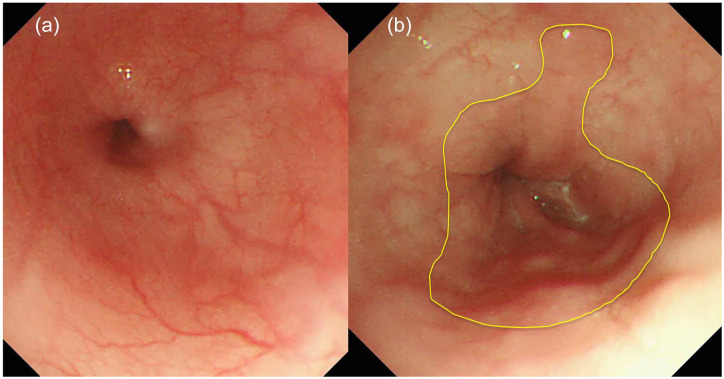 Multichannel impedance monitoring for distinguishing nonerosive reflux esophagitis with minor changes on endoscopy in children.