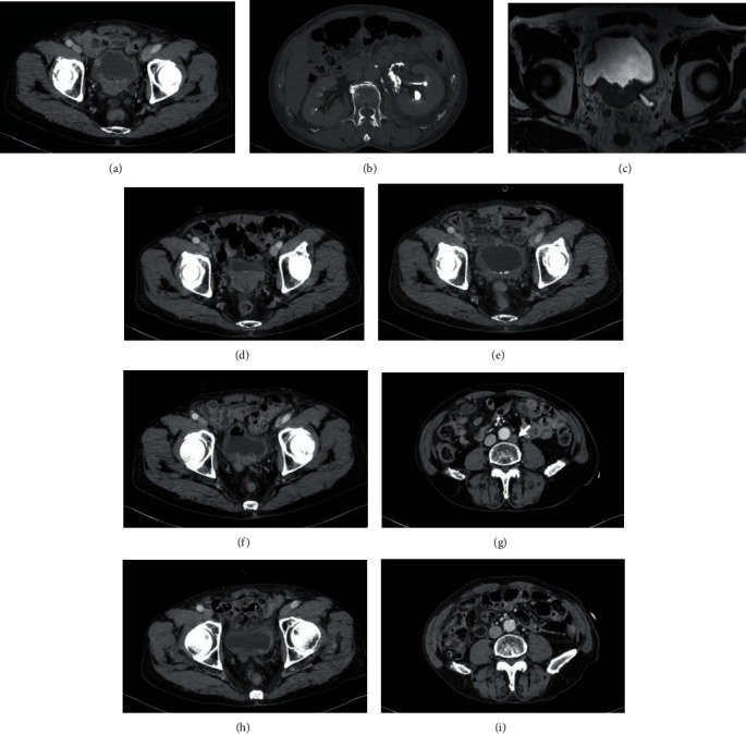 Successful Response of Pembrolizumab Rechallenge after Radiotherapy for a Patient with Bladder Cancer of Nonresponse of Pembrolizumab First Challenge.