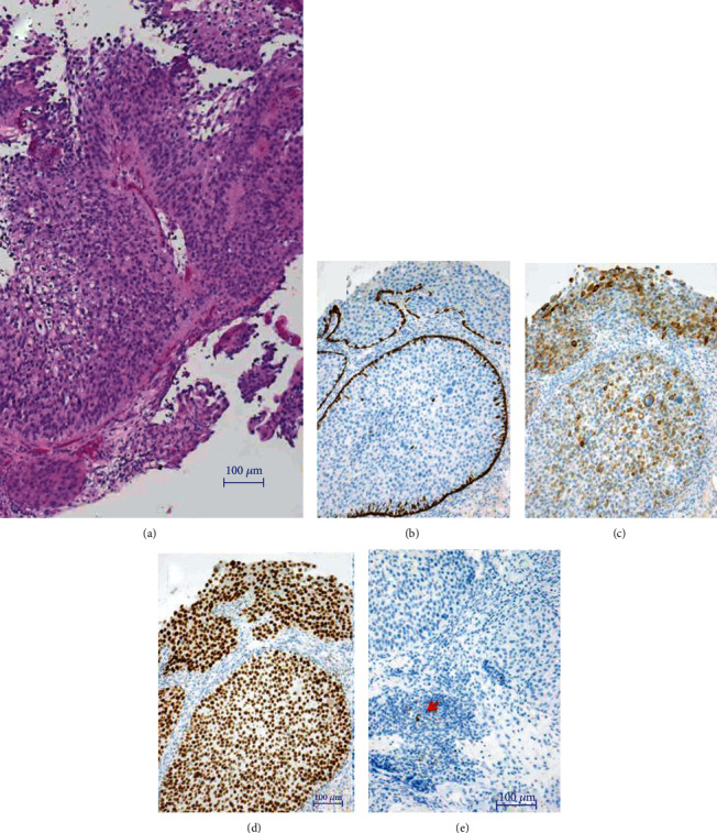 Successful Response of Pembrolizumab Rechallenge after Radiotherapy for a Patient with Bladder Cancer of Nonresponse of Pembrolizumab First Challenge.