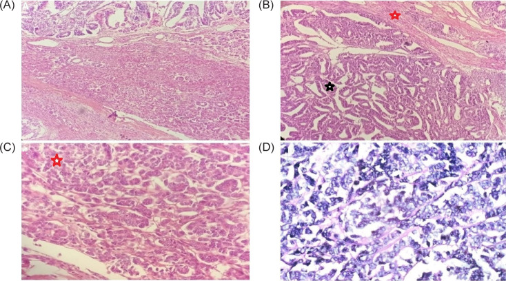 Wilms' Tumor in Adults-Conventional and Unconventional Presentations of a Rare Entity with a Review of Literature.