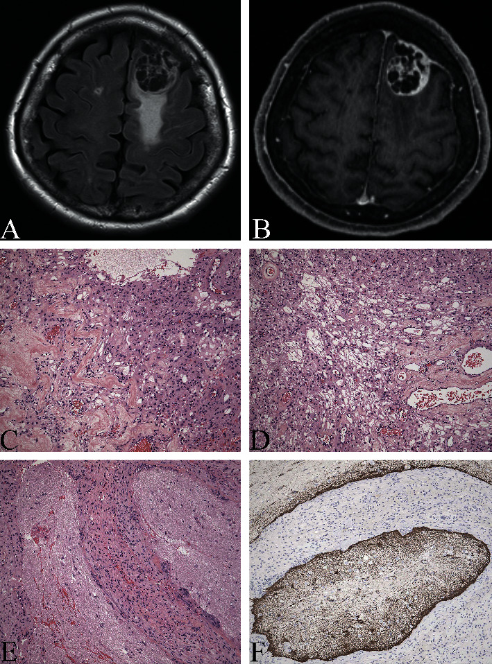 Neurologic Imaging in a Patient with Cirrhosis and Altered Mental Status: To CT or Not to CT.