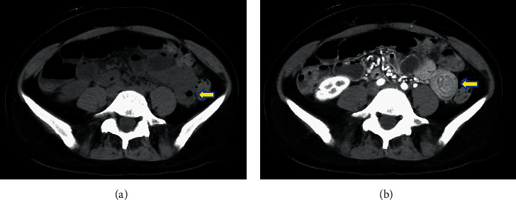 Intraoperative Endoscopy in Transient Adult Jejunojejunal Intussusception.