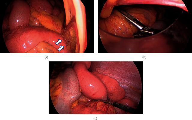 Intraoperative Endoscopy in Transient Adult Jejunojejunal Intussusception.