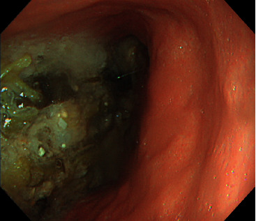 Intraoperative Endoscopy in Transient Adult Jejunojejunal Intussusception.