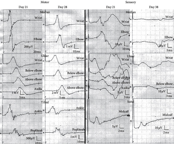 Development of Acute Inflammatory Demyelinating Polyneuropathy 11 Days after Spinal Surgery: A Case Report and Literature Review.