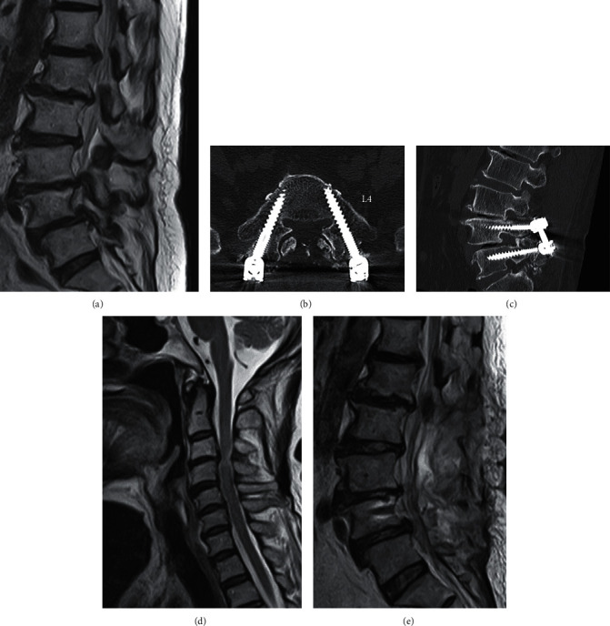 Development of Acute Inflammatory Demyelinating Polyneuropathy 11 Days after Spinal Surgery: A Case Report and Literature Review.