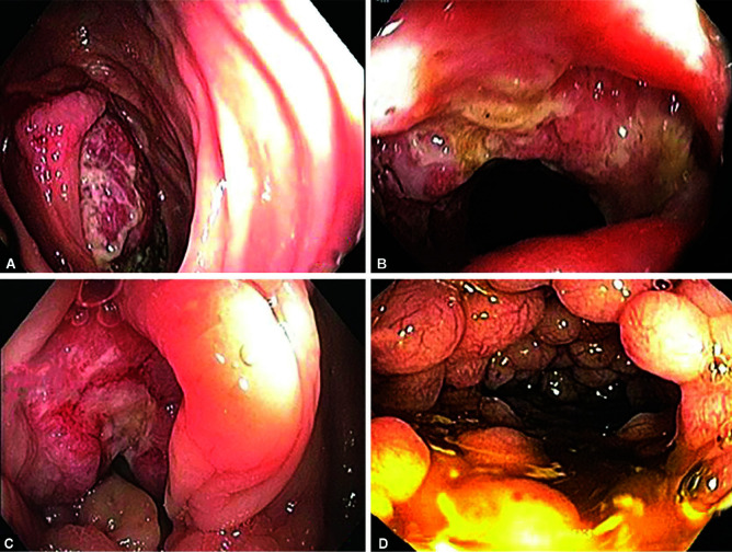 Primary Intestinal Lymphoma: Clinicopathological Characteristics of 55 Patients.