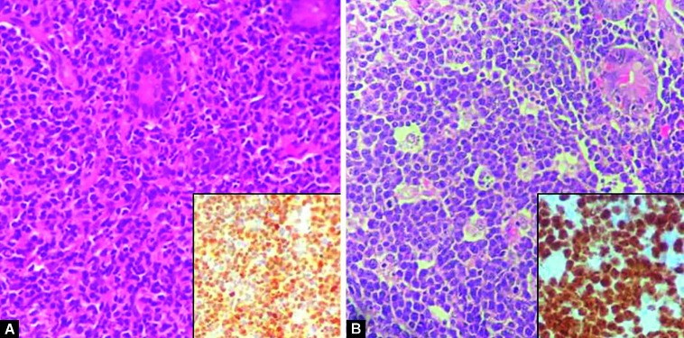 Primary Intestinal Lymphoma: Clinicopathological Characteristics of 55 Patients.