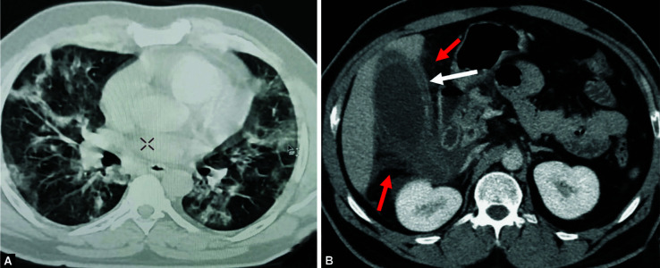 Abdominal Computed Tomography Findings among COVID-19 Patients with Index Gastrointestinal Manifestations: A Preliminary Single-center Experience.