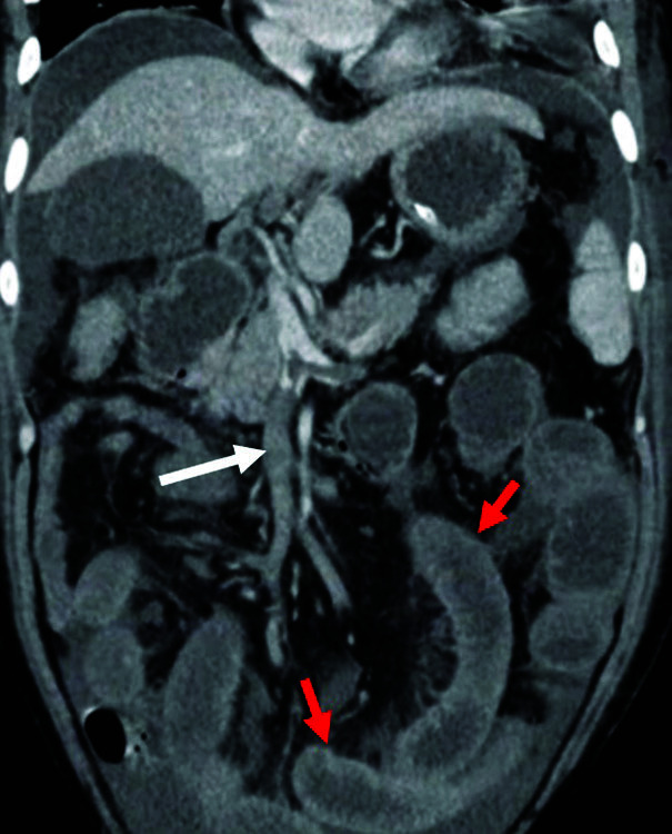 Abdominal Computed Tomography Findings among COVID-19 Patients with Index Gastrointestinal Manifestations: A Preliminary Single-center Experience.