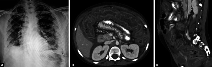 Abdominal Computed Tomography Findings among COVID-19 Patients with Index Gastrointestinal Manifestations: A Preliminary Single-center Experience.