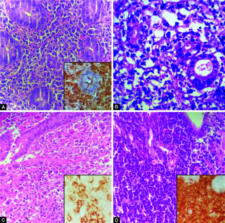 Primary Intestinal Lymphoma: Clinicopathological Characteristics of 55 Patients.