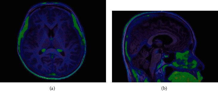 The Evaluation of Tau Deposition with [<sup>18</sup>F]PI-2620 by Using a Semiquantitative Method in Cognitively Normal Subjects and Patients with Mild Cognitive Impairment and Alzheimer's Disease.