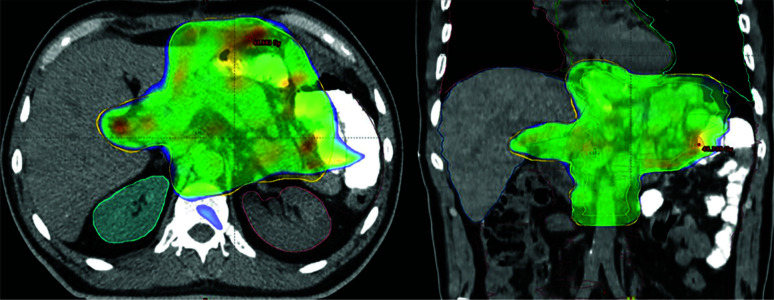 Adjuvant Treatment of Gastric Cancer in the D2 Dissection Era: A Real-life Experience from a Multicenter Retrospective Cohort Study.