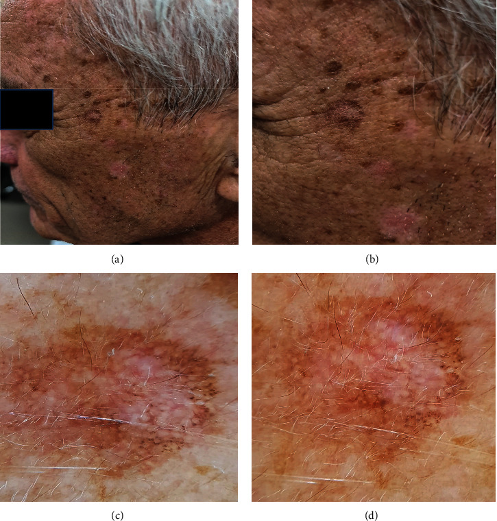 Diagnosis and Management of Lentigo Maligna: Clinical Presentation and Comprehensive Review.