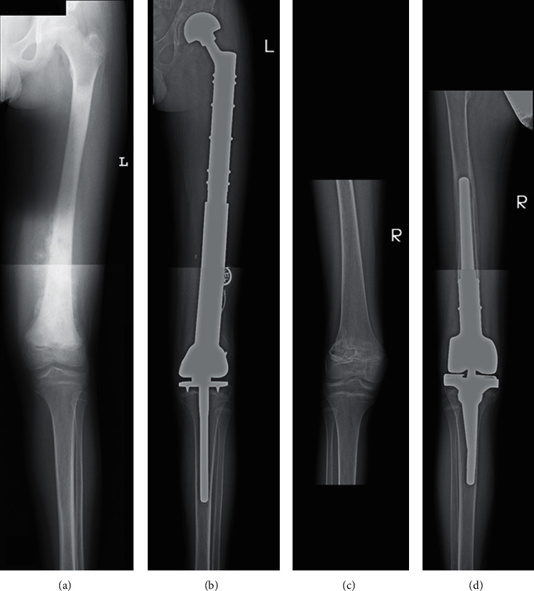 Double Endoprosthesis in the Management of Refractory Metastatic Primary Bone Tumors in Children and Young Adults.