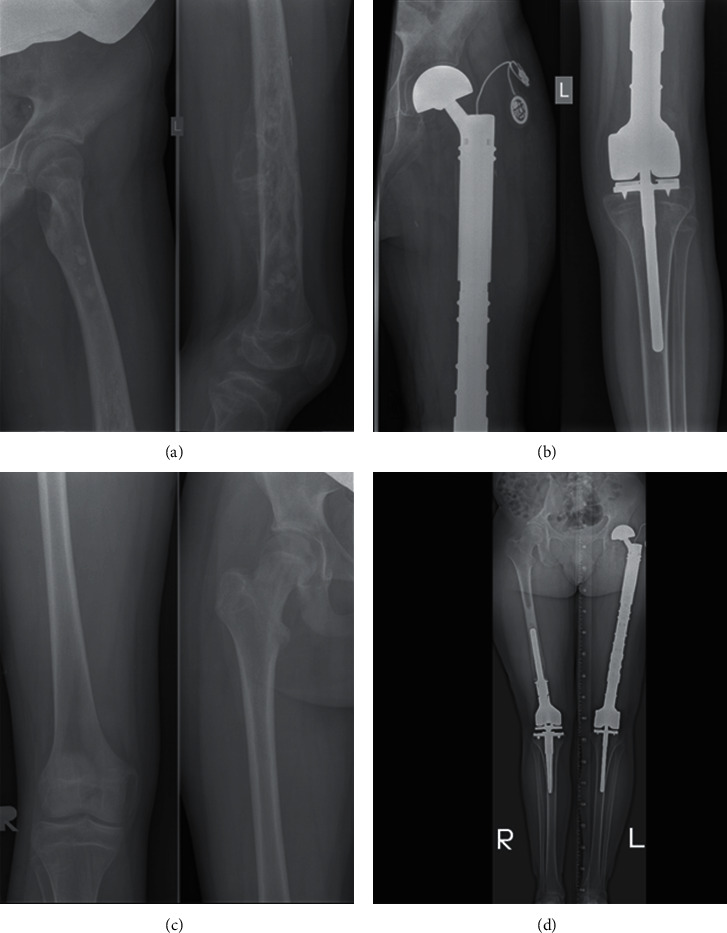 Double Endoprosthesis in the Management of Refractory Metastatic Primary Bone Tumors in Children and Young Adults.