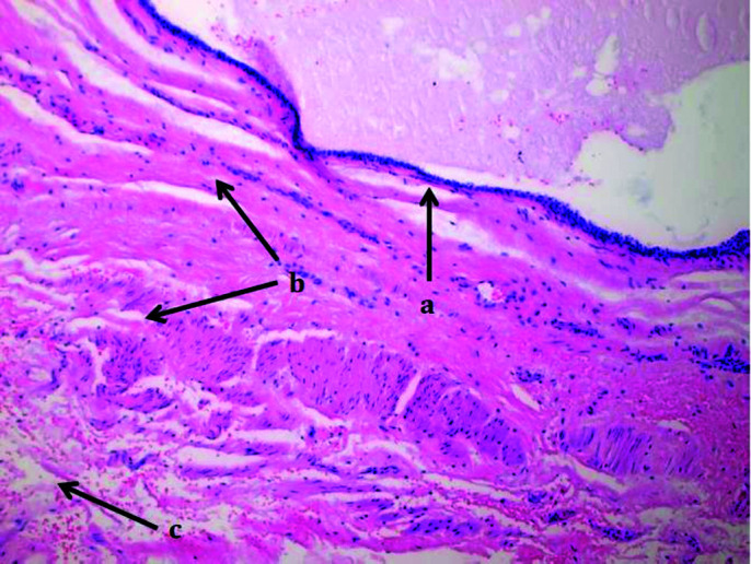 Robotic-Assisted Laparoscopic Resection of Tailgut Cysts.