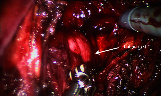 Robotic-Assisted Laparoscopic Resection of Tailgut Cysts.