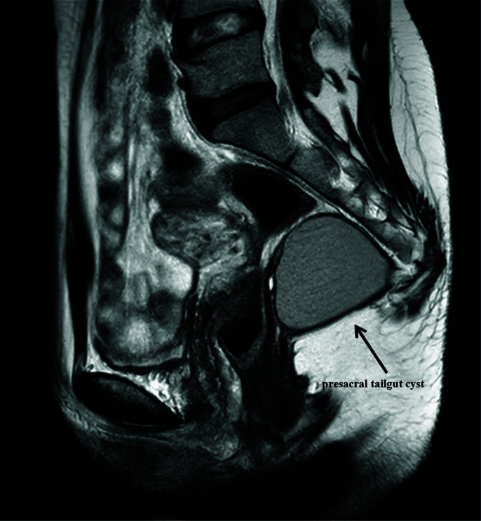 Robotic-Assisted Laparoscopic Resection of Tailgut Cysts.