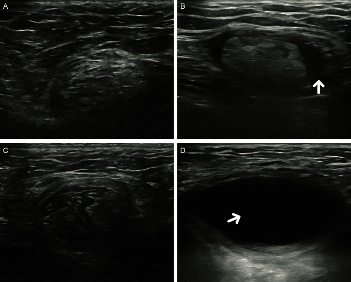 Feasibility of Laparoscopic Transabdominal Preperitoneal Hernioplasty for Incarcerated Inguinal Hernia.