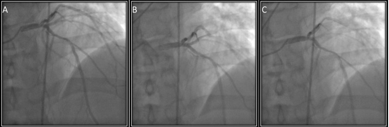 Pulsation of catheter during coronary angiography: Is it a sign of severe aortic regurgitation?